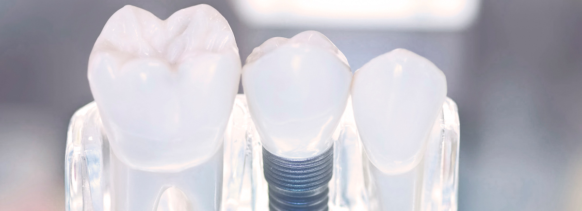 dental-implant